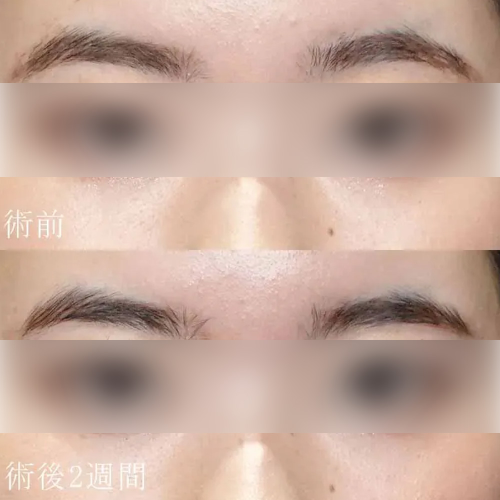 ［テスト04］埋没法ループ