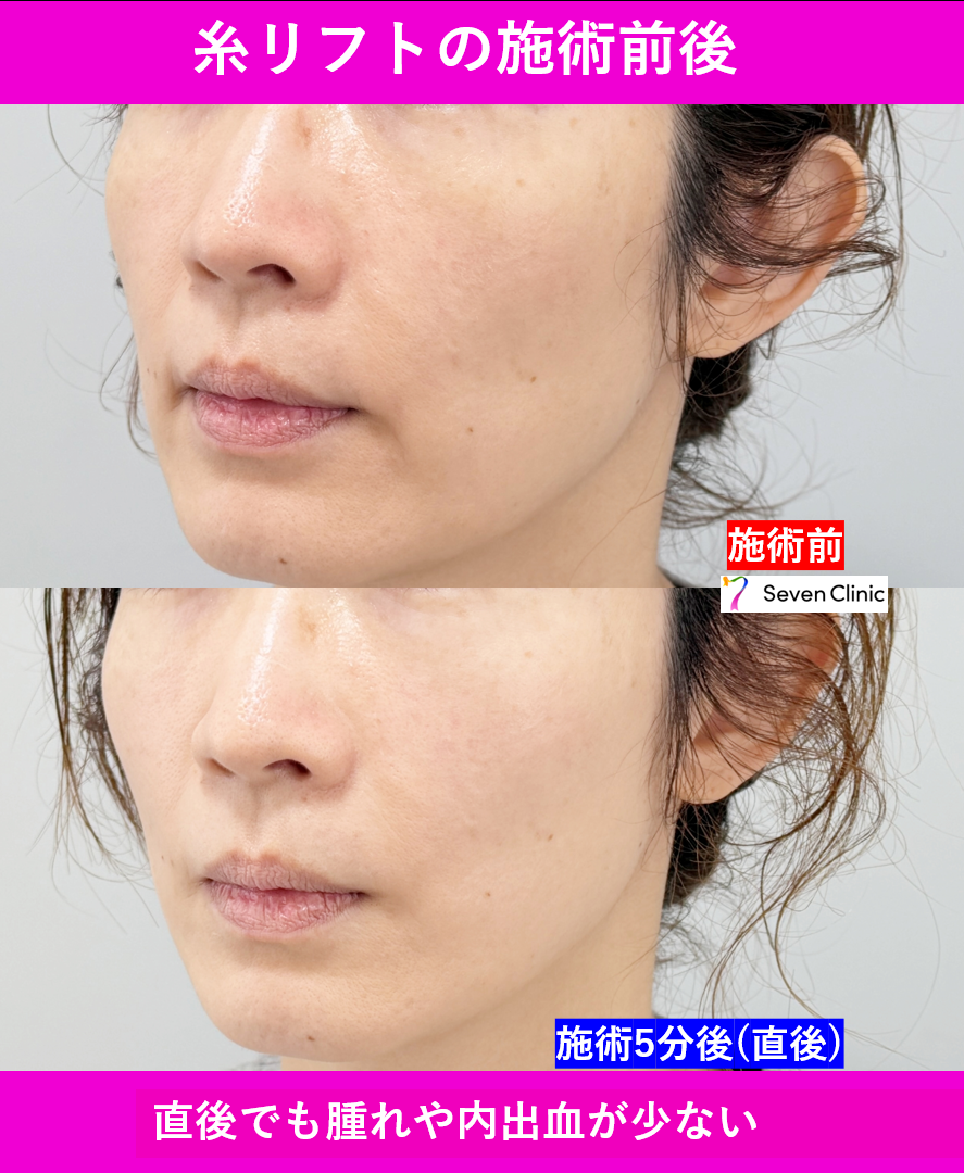 糸リフトの施術前後の比較
